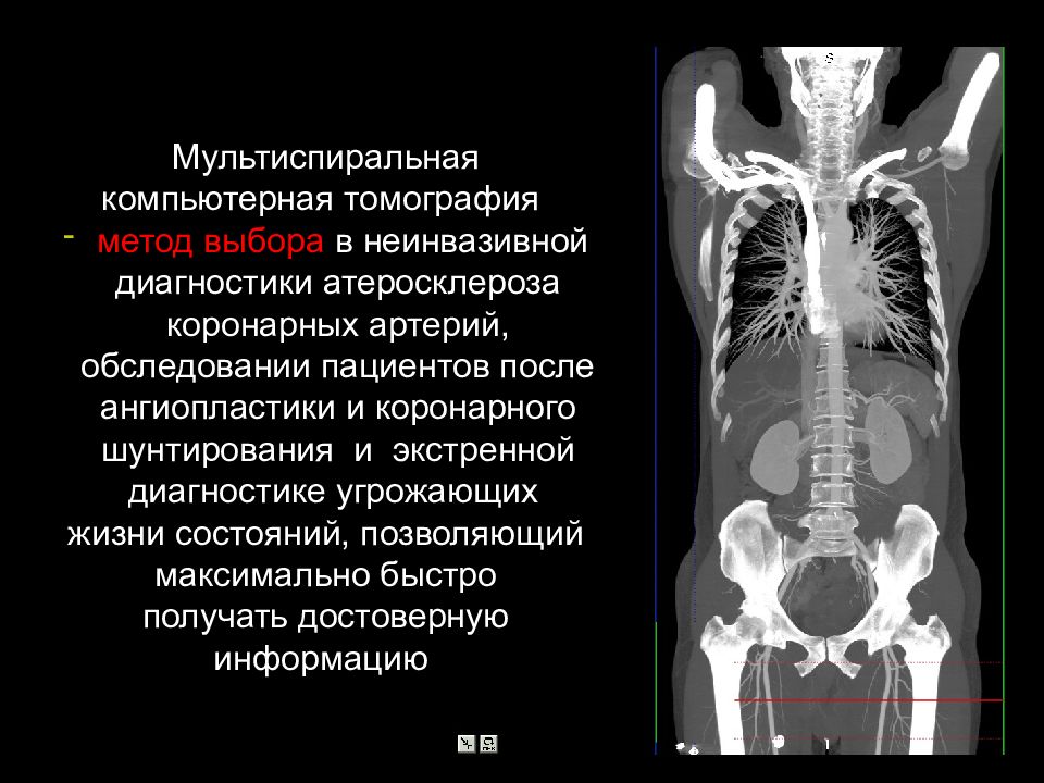 Что такое мскт. Мультиспиральная многослойная компьютерная томография. Мультиспиральная (многосрезовая) кт (МСКТ). Компьютерная томография мето. Метод мультиспиральной компьютерной томографии.