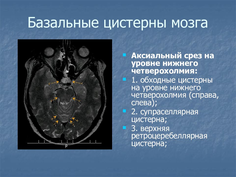 Цистерна головного мозга расширена