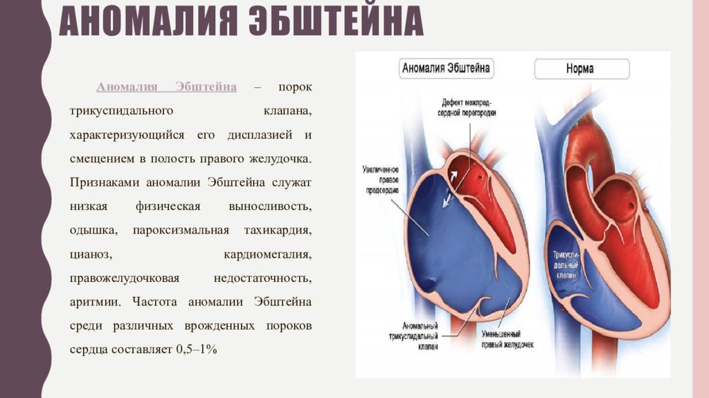 При аномалии эбштейна легочный рисунок