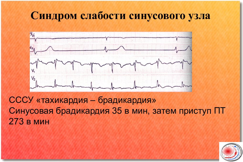 Карта вызова скорой медицинской помощи синусовая брадикардия