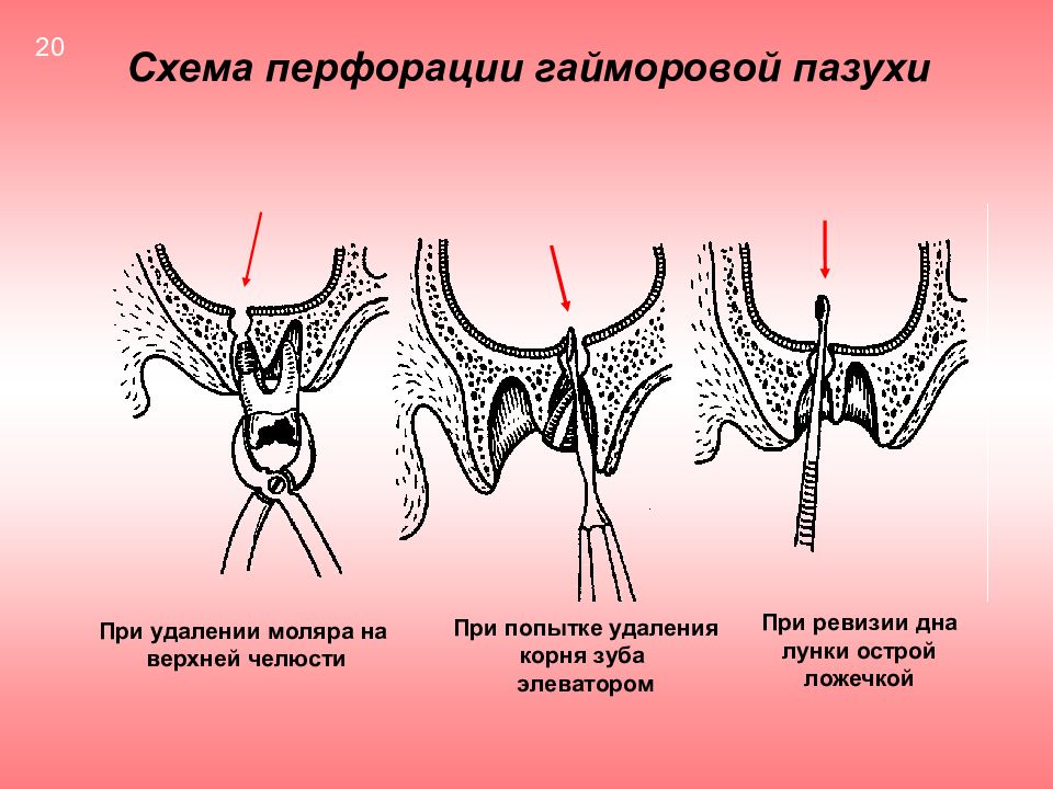 Одонтогенный синусит презентация