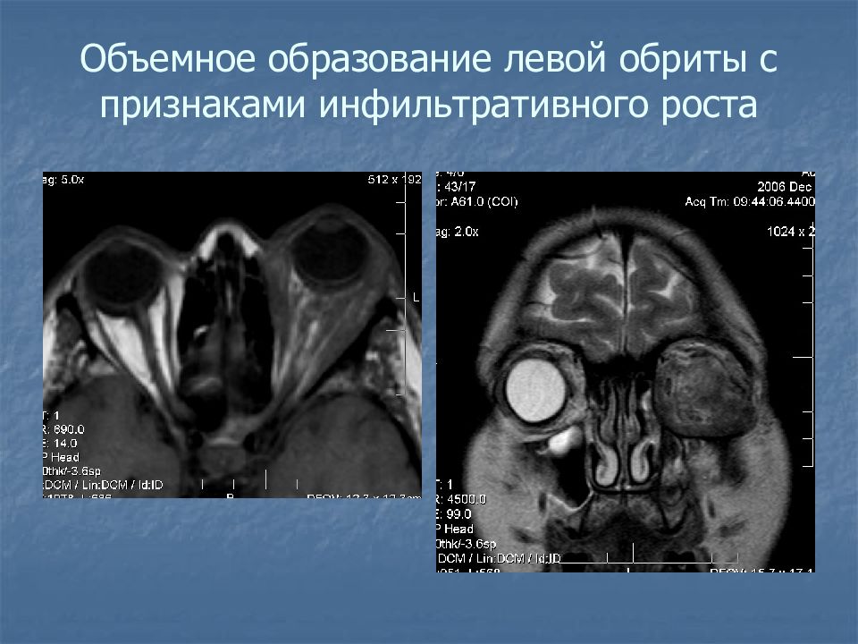 Мягкое объемное образование