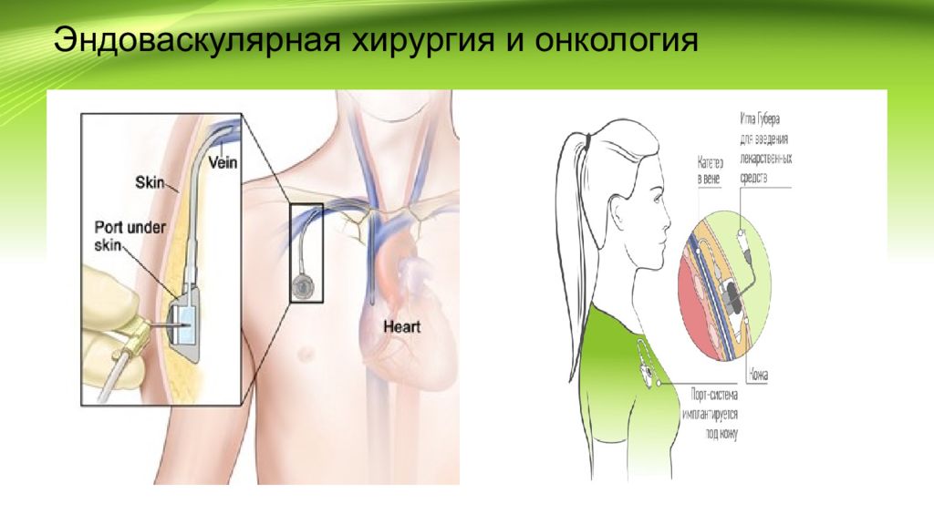 Онкология хирургия презентация