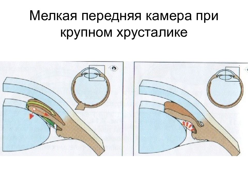 Патология внутриглазного давления презентация