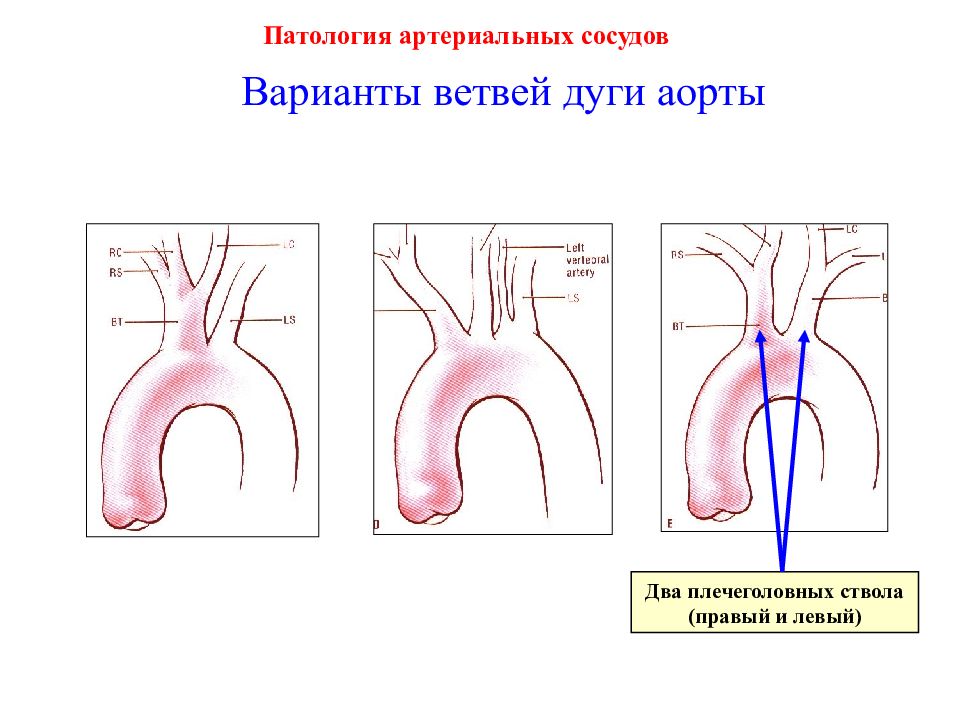 Ветви и дуги аорты схема