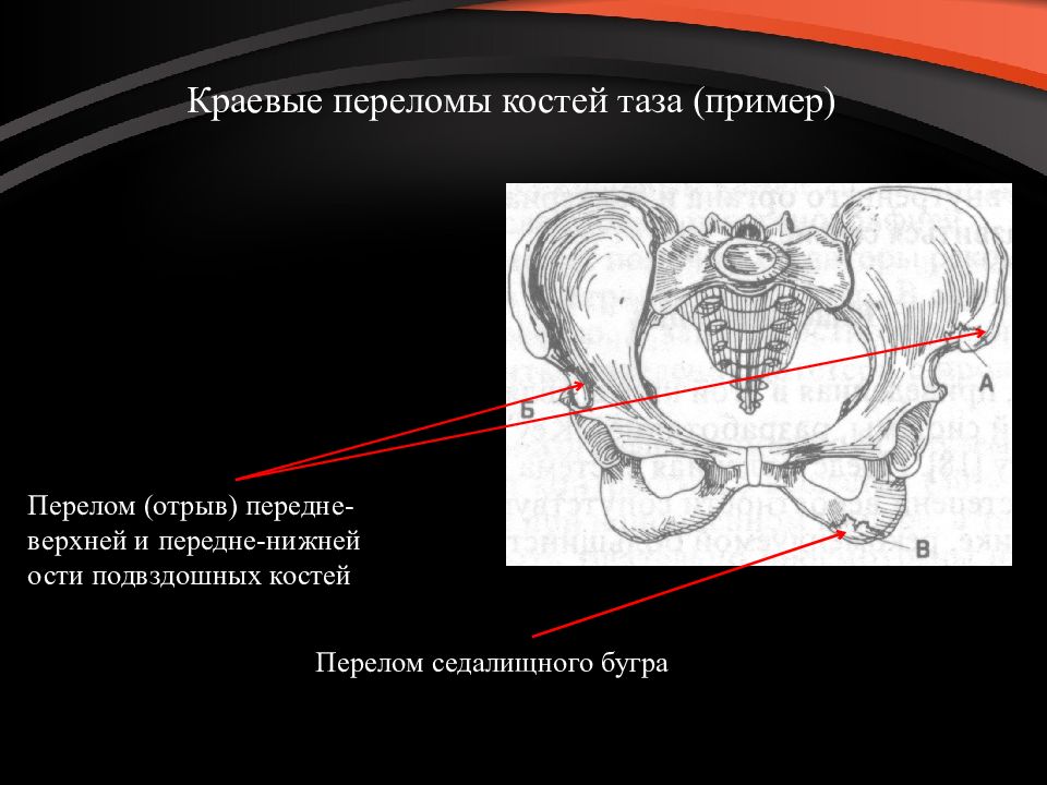 Презентация на тему перелом костей таза