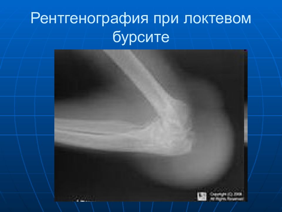Локтевой рентген. Бурсит локтевого отростка рентген. Известковый бурсит локтевого сустава на рентгене. Бурсит локтевого сустава рентген эпикондилит. Бурсит локтевого сустава рентген.