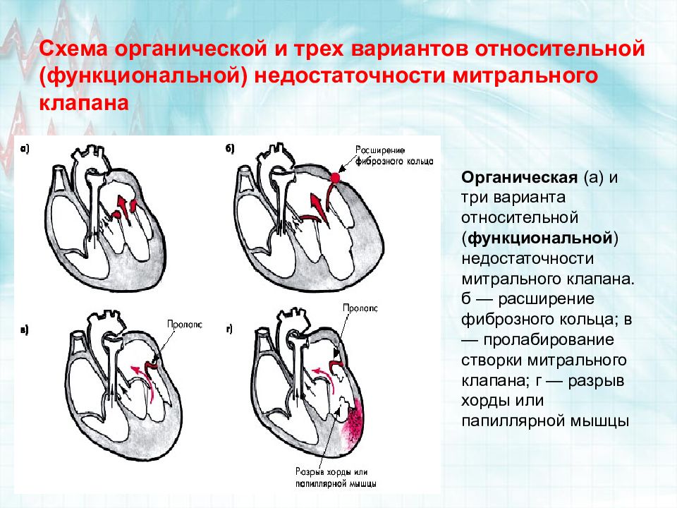 Приобретенные пороки сердца схема