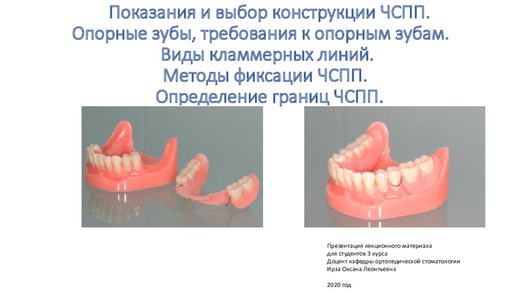 Показания и выбор конструкции ЧСПП. Опорные зубы, требования к опорным зубам. Виды кламмерных линий. Методы фиксации ЧСПП. Определение границ ЧСПП.