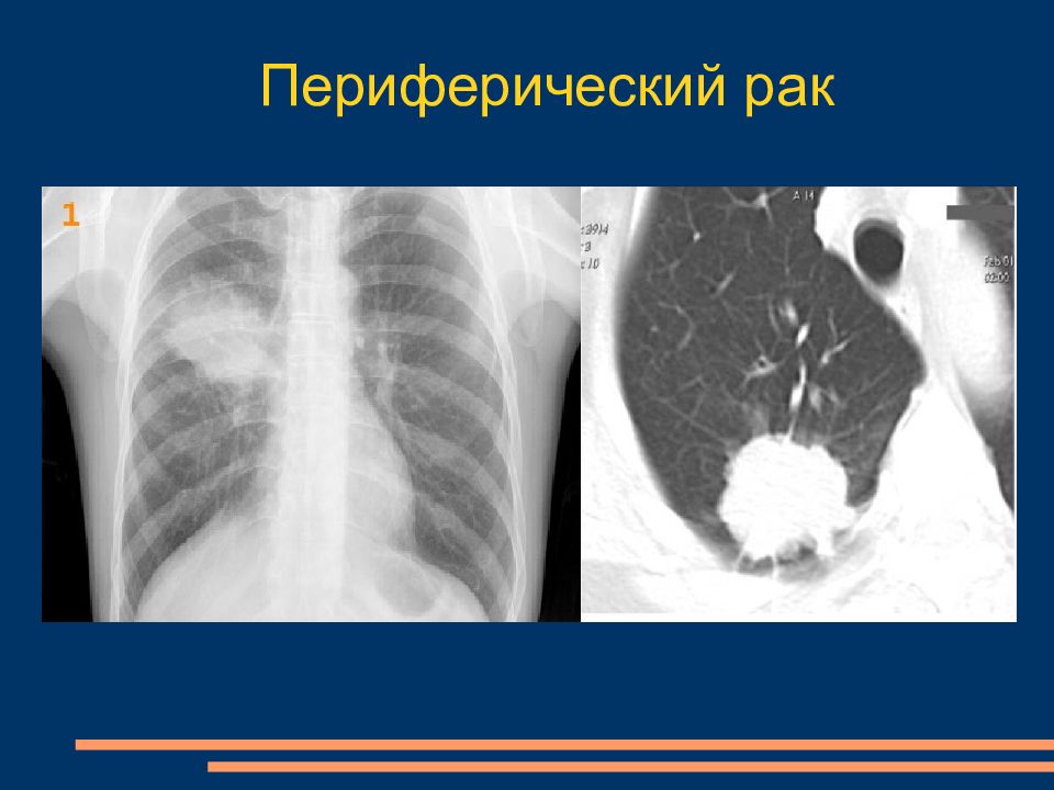 Диагноз периферический рак. Заболеваний органов грудной полости. Патология органов грудной полости. Лучевая диагностика заболевания органов грудной полости. Устранение патологии органов грудной полости лазером.