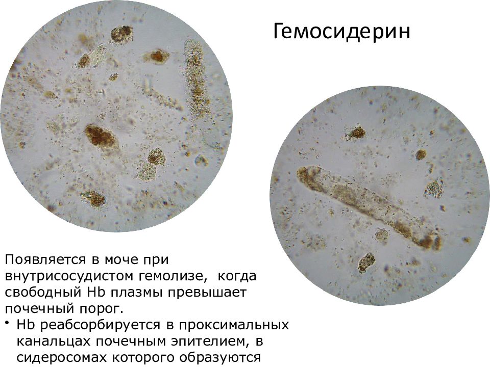 Осадки мочи