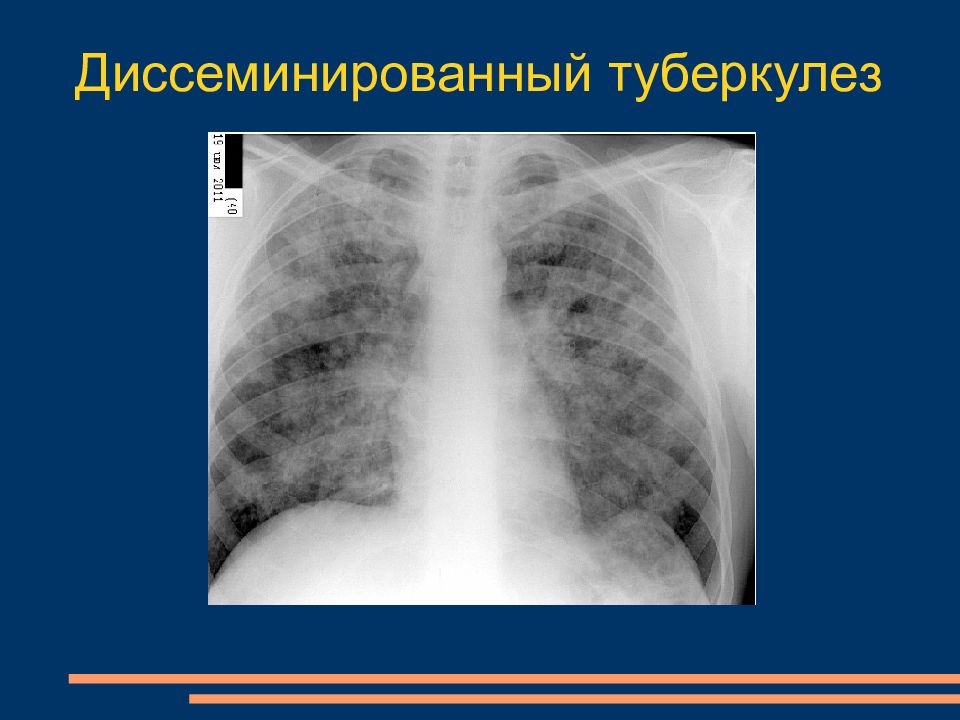 Лучевая диагностика легких презентация