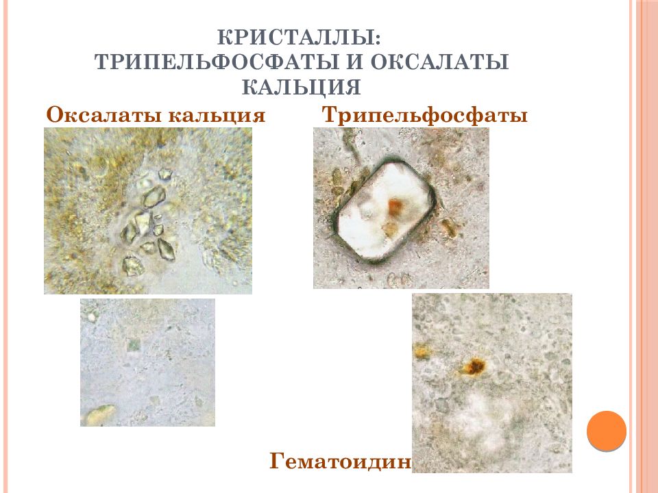 Кристаллы оксалата кальция. Микроскопия кала трипельфосфаты. Оксалаты трипельфосфаты. Кристалл трипельфосфаты в Кале.