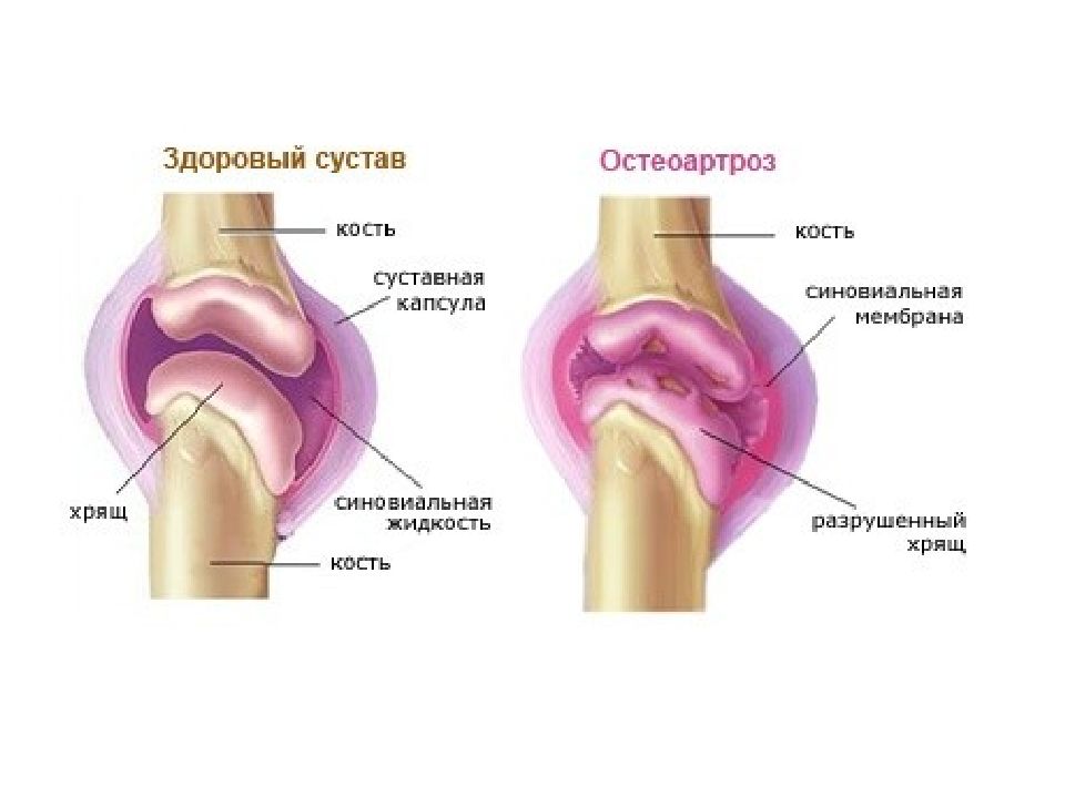 .Деформирующий остеоартрит остеоартроз. Деформирующий остеоартроз коленного сустава. Остеоартроз плечевого сустава. Разрушение тканей сустава.