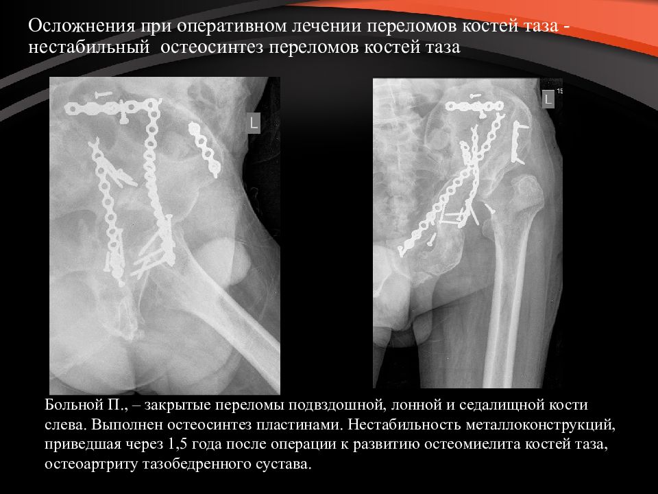 Презентация на тему перелом костей таза
