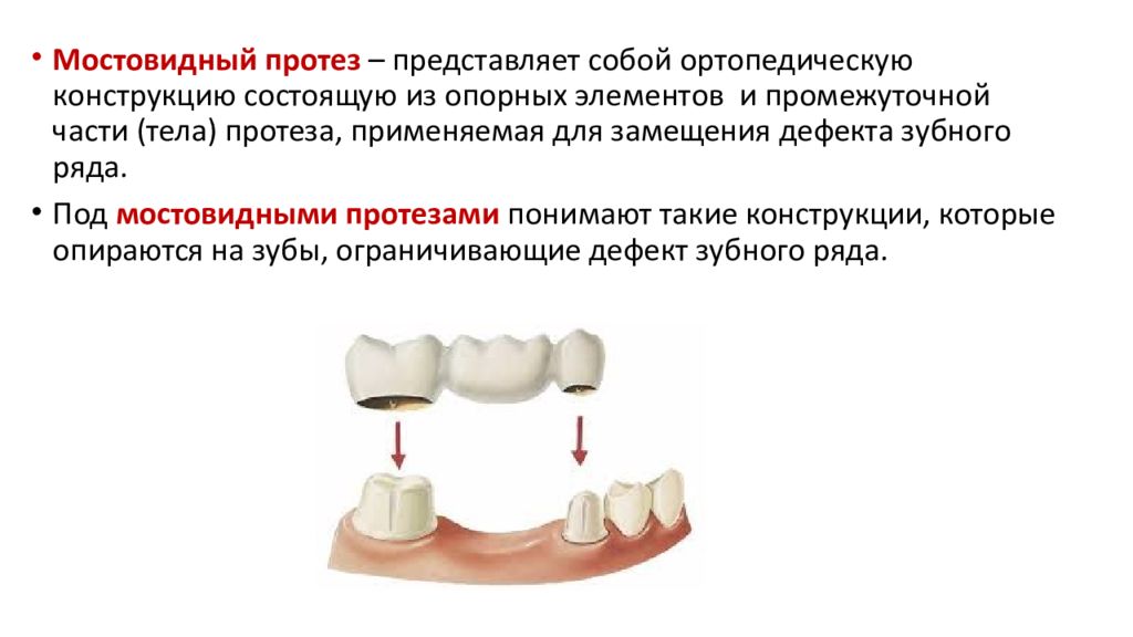 Изготовление мостовидных протезов презентация