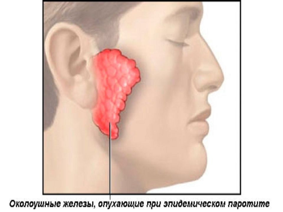 Паротит у детей презентация