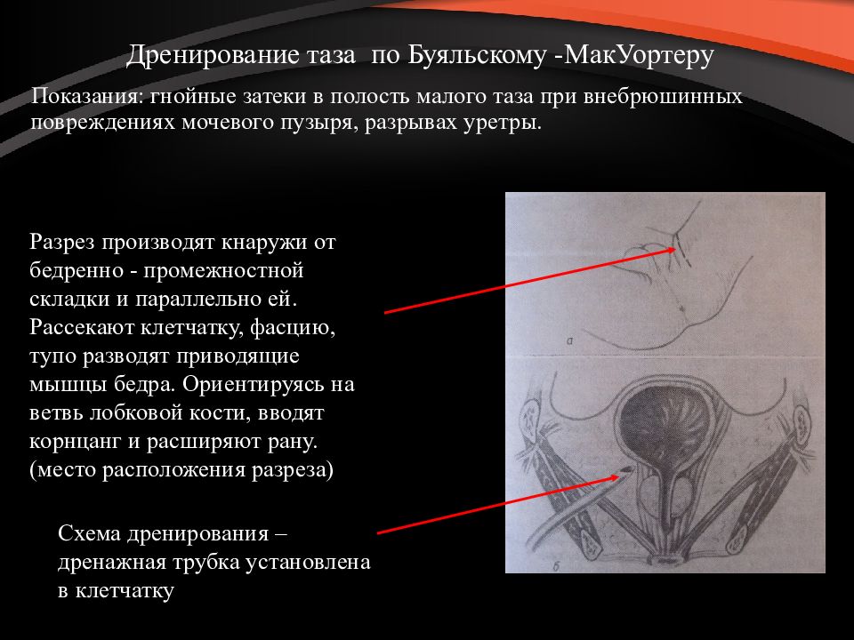 Полость таза. Полость малого таза. Дренирование мочевого пузыря. Дренирование полости малого таза. Переломы костей таза презентация.