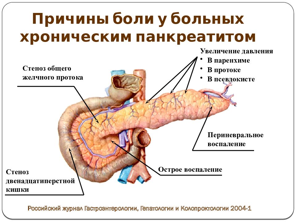 Положение фовлера при панкреатите картинка