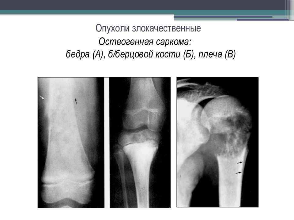 Остеогенная саркома