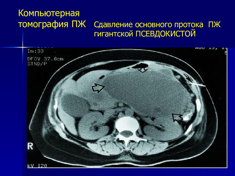 Псевдокиста поджелудочной железы. Псевдокиста поджелудочной железы кт. Псевдокиста головки поджелудочной железы на кт. Кисты псевдокисты поджелудочной железы кт. Псевдокиста поджелудочной железы мрт.