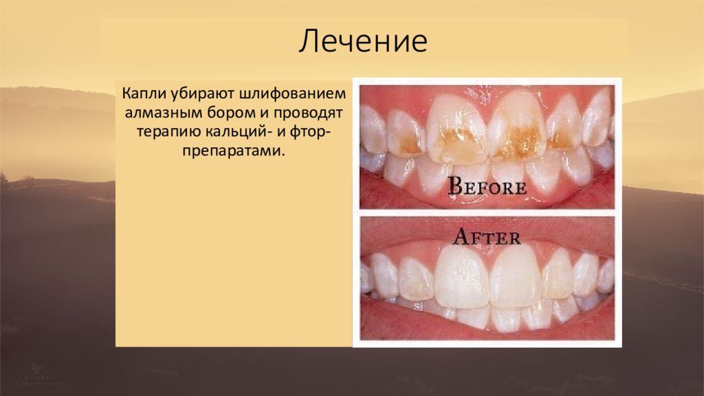 Каплю убрали. Гиперплазия эмали эмалевые капли.