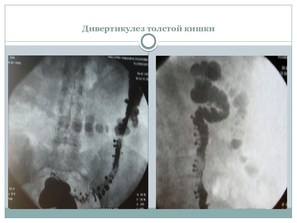 Дивертикулы кишечника. Дивертикулы толстой кишки рентген. Дивертикулярная болезнь Толстого кишечника диагностика. Дивертикул толстой кишки макропрепарат. Дивертикулярная болезнь рентген.