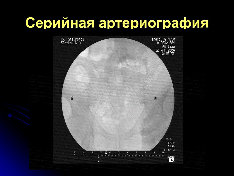 Артериография. Показания к артериографии.