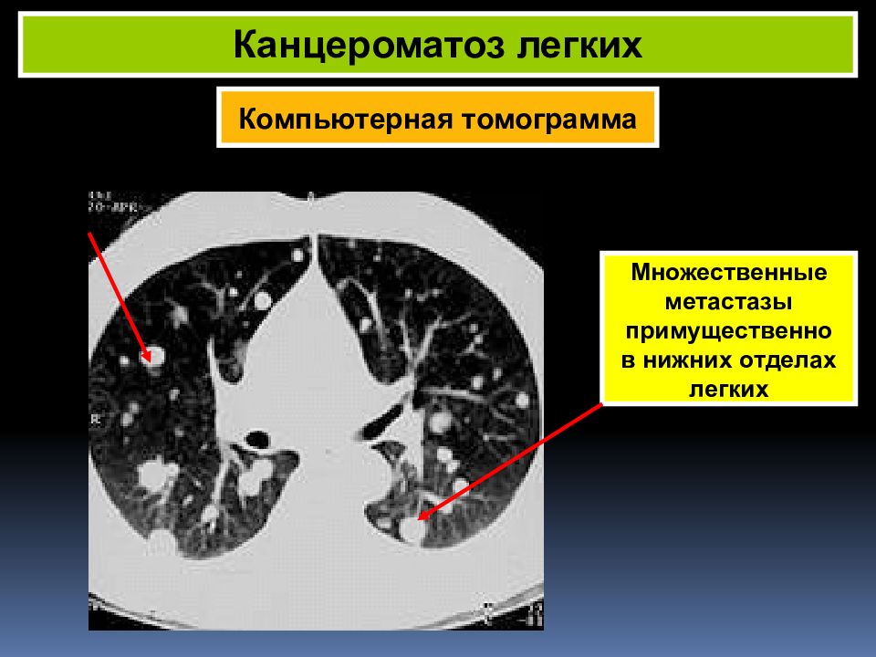 Карциноматоз. Лимфогенный карциноматоз кт. Лимфогенный канцероматоз кт. Канцероматоз лёгких на кт. Карциноматоз легких кт.