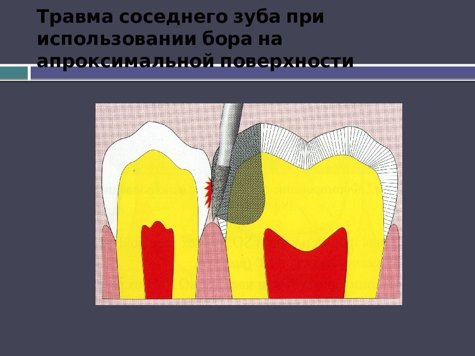 Травма соседнего зуба при использовании бора на апроксимальной поверхности