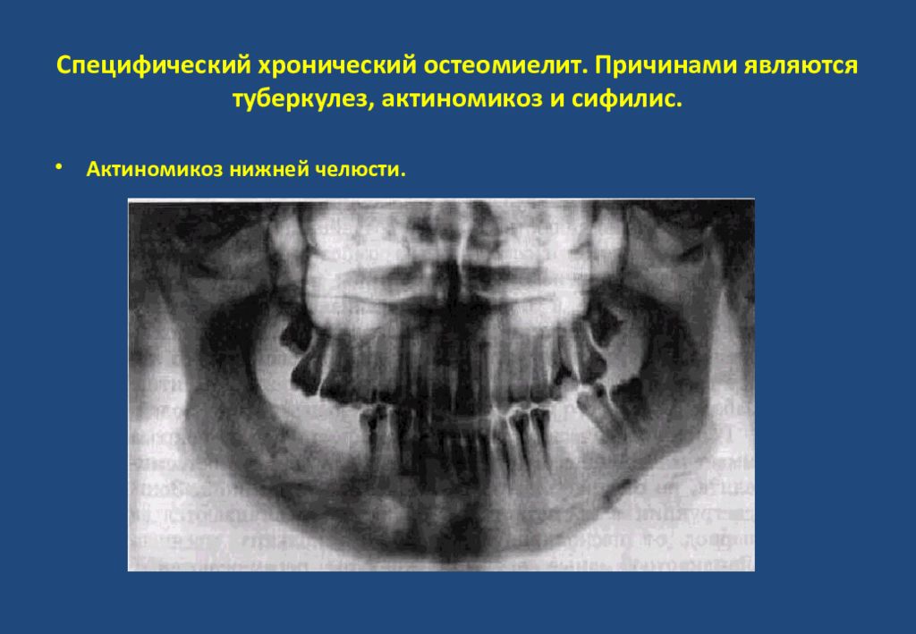 Рентгенодиагностика остеомиелита презентация