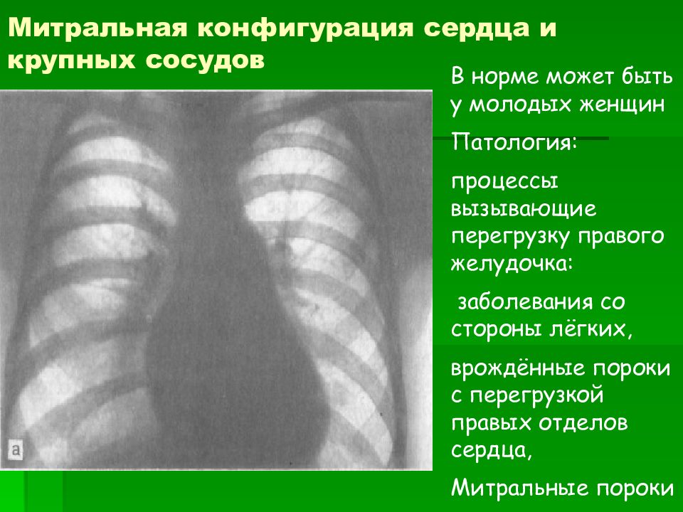 Конфигурация сердца. Митральная конфигурация сердца рентген. Митральная форма сердца рентген. Митральная конфигурация сердца рентген признаки.