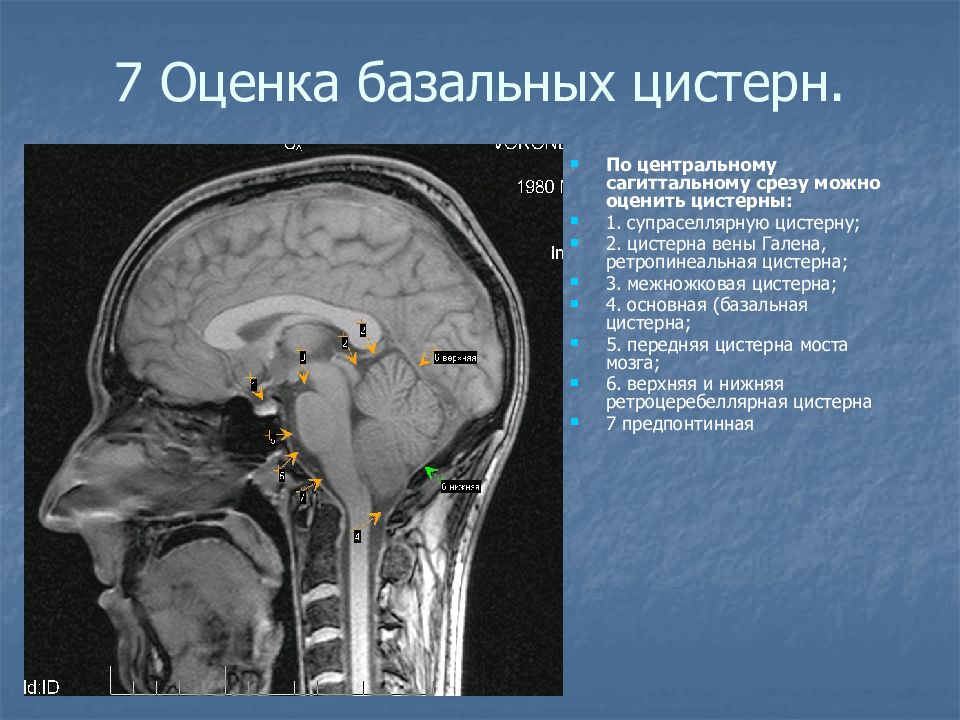 Цистерны мозга расширены. Базальные цистерны головного мозга кт анатомия. Цистерны мозжечка анатомия. Верхняя мозжечковая цистерна мозга мрт. Базальные цистерны головного мозга кт.