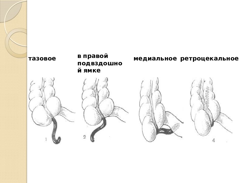 Гипоспадия это