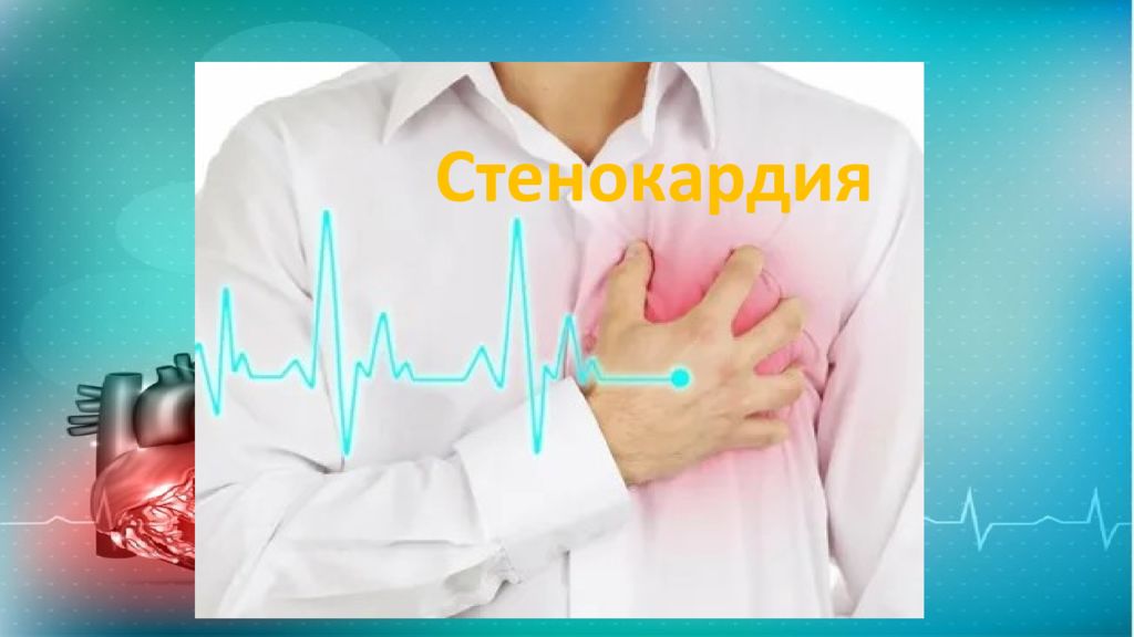 Стенокардия