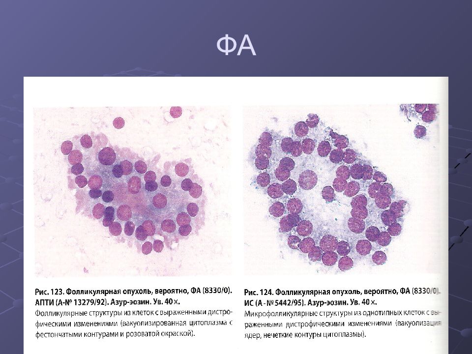 Цитологическая картина фолликулярной в клеточной опухоли щитовидной железы bethesda iv