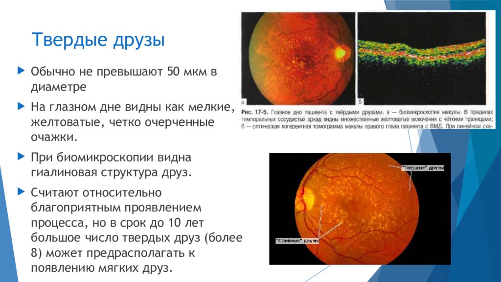 Возрастная макулярная дегенерация презентация