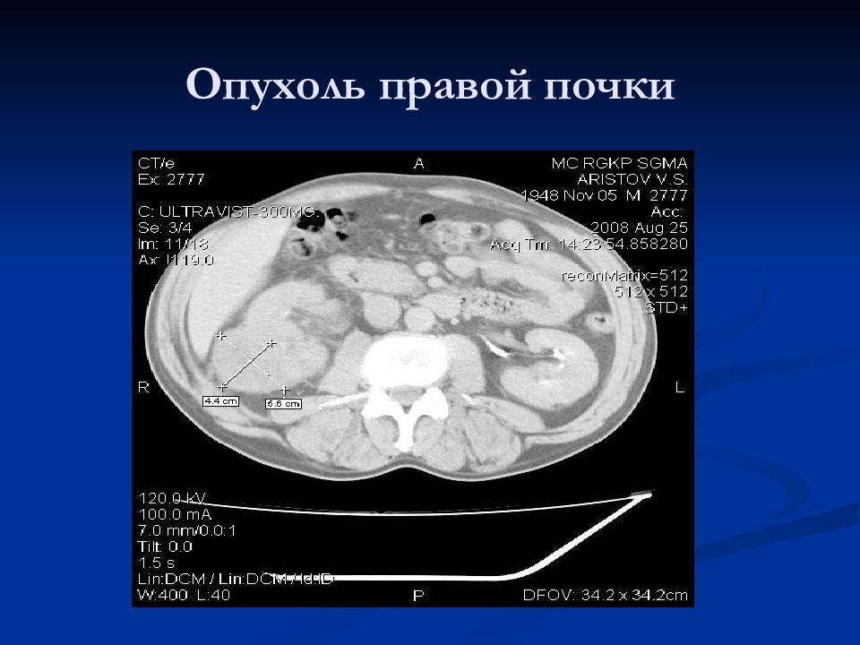 Рак правого. Рентгенологическим симптомом опухоли почки является:. Объемное образование почки. Объемное образование правой почки. Лучевая диагностика опухолей почек.