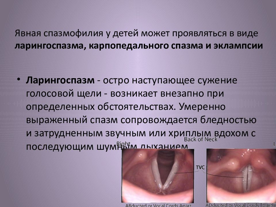 Ларингоспазм у детей презентация