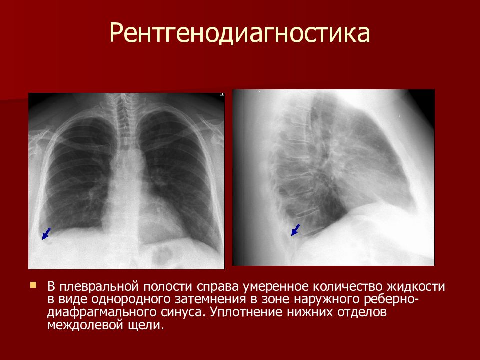 Полость право. Междолевой плеврит рентген. Междолевой плеврит справа рентген. Плевральные наслоения в легких рентген. Плеврит справа рентген.