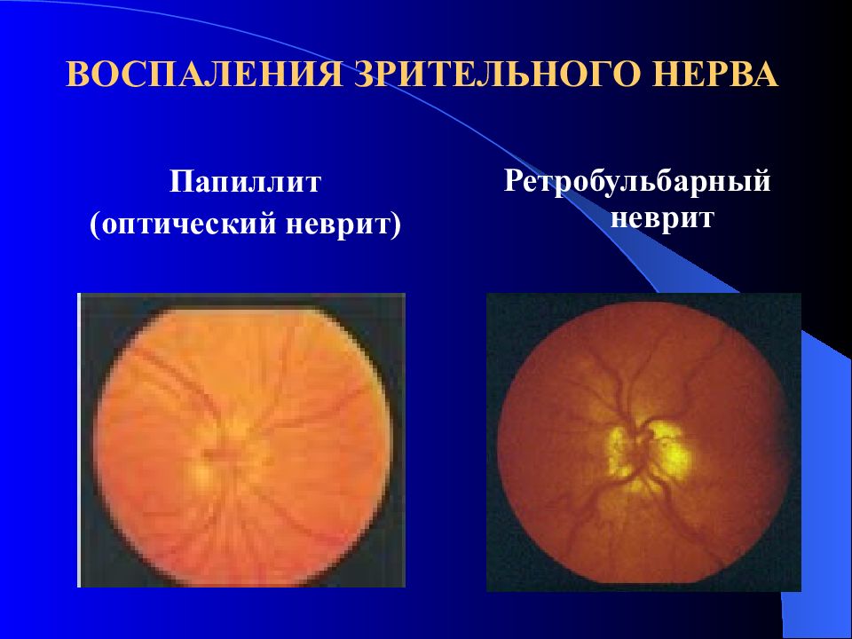 Неврит зрительного нерва презентация