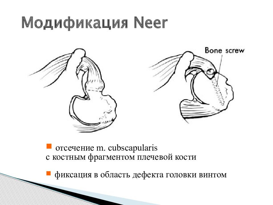 Привычный вывих плеча презентация