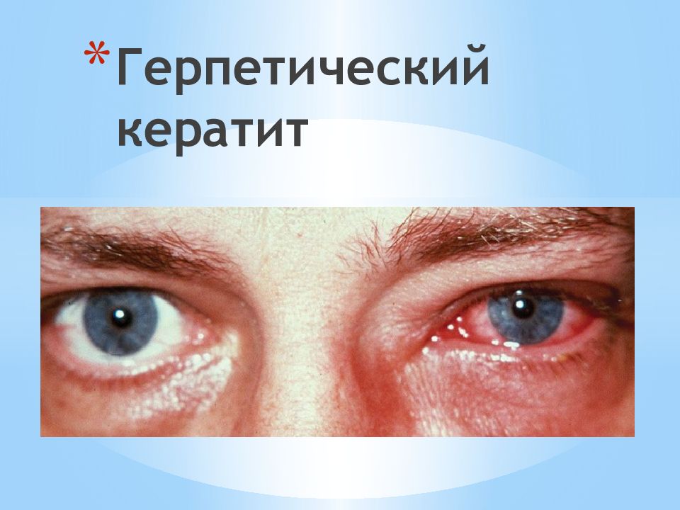 Герпетический кератит