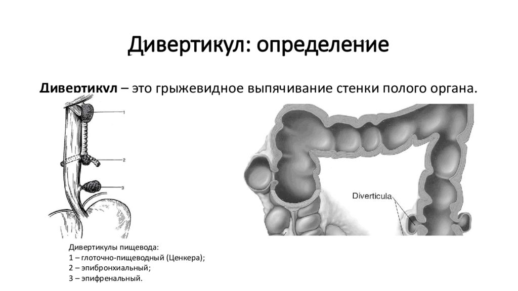 Рост опухоли в стенку полого органа называется