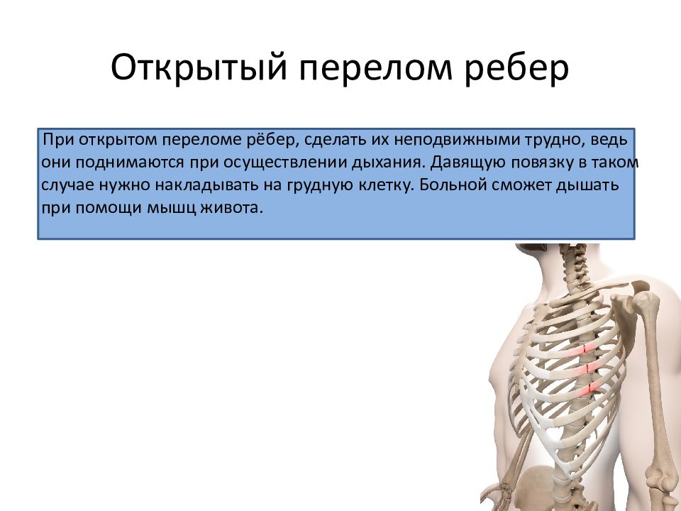 Сколько болят переломы ребер. Наружный перелом ребра. Перелом ребер открытый перелом.