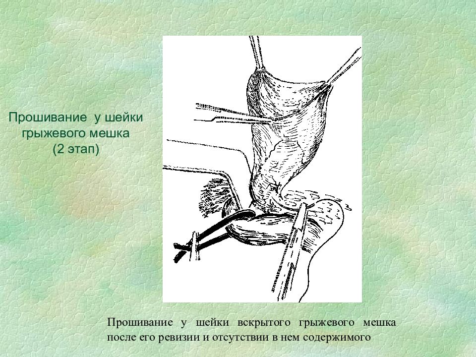 Грыжи передней брюшной стенки презентация