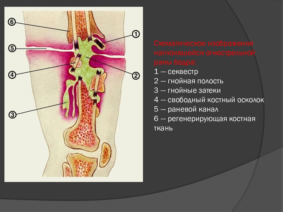 Гнойная остеология. Пути распространения гнойных ЗАТЕКОВ. Секвестр патологическая анатомия.