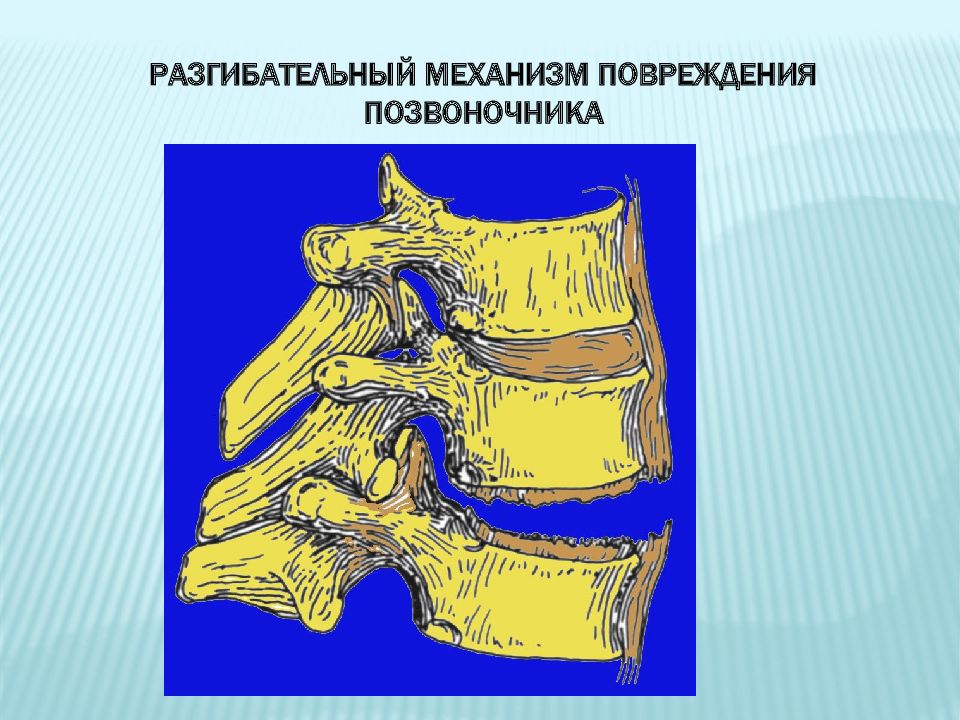 Повреждение позвоночника. Механизмы повреждения позвоночника. Механизмы травмы позвоночника. Классификация повреждение позвоночника и таза.