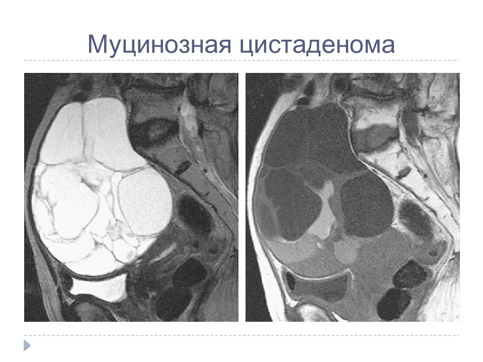 Муцинозная цистаденома поджелудочной железы. Цистаденокарцинома поджелудочной железы кт. Серозная цистаденофиброма гистология. Муцинозная опухоль на мрт. Серозная цистаденома мрт.