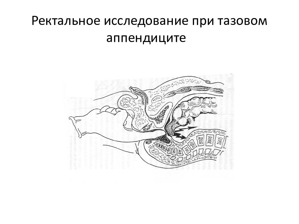 Ректальная железа